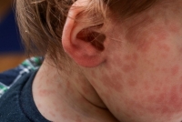 Entre Ríos: Alertan sanitaria en el país tras la detección de un caso de sarampión