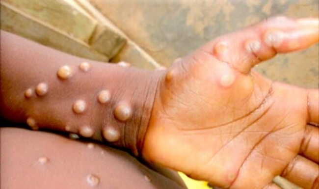 La OMS declaró al brote de mpox (viruela del mono) emergencia sanitaria mundial