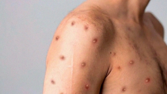 En la ciudad de Buenos Aires, se da el primer caso de la variante más contagiosa de viruela símica en Argentina
